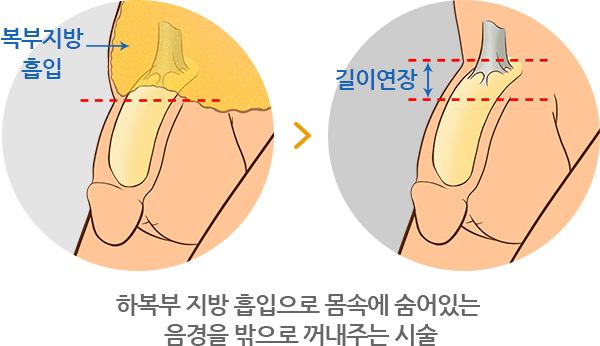 하이맨 함몰음경교정 길이연장술 - 하복부 지방 흡입으로 몸속에 숨어있는 음경을 밖으로 꺼내주는 시술