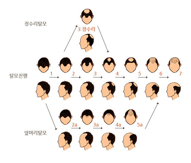 탈모의 진행